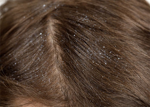 ¿Estás lavando mal tu cuero cabelludo? Esto es lo que podría estar causando…